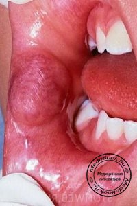 Гемангиомы рта и языка