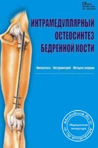 Интрамедуллярный остеосинтез бедренной кости: Имплантаты, инструментарий, методика операций, Charfix system, 2004 г. 