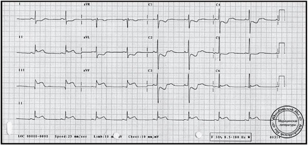 Электрокардиограмма (ЭКГ) при Остром инфаркте миокарда (ОИМ)