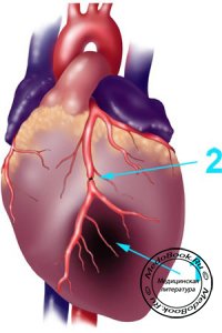 Острый инфаркт миокарда: Клинический случай