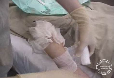 Повязка Перчатка на пораженную ожогом кисть: Медицинское видео онлайн