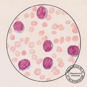 Мазок из крови больного острым лейкозом (гемоцитобластозом)