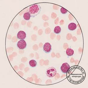 Мазок из крови больного острым лейкозом (гемоцитобластозом)