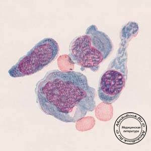 Различные формы ретикулоэндотелиальных клеток (гистиоцитов)