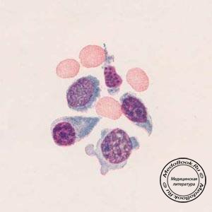 Различные формы лимфоидно-ретикулярных клеток