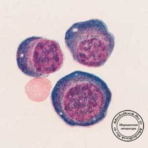 Различные формы плазматических клеток (наиболее крупная из них соответствует клетке Тюрка)