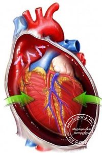 Угрожающая тампонада сердца при экссудативном перикардите