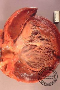 Патологическая анатомия дилатационной кардиомиопатии