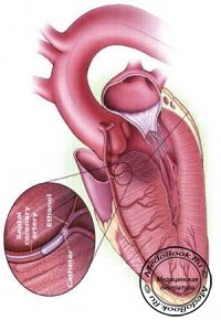 Классификация гипертрофической кардиомиопатии