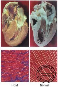 Патологическая анатомия гипертрофической кардиомиопатии