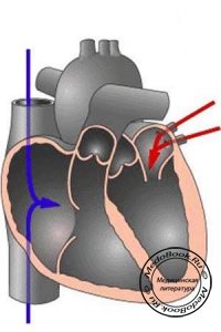 Клиническая картина гипертрофической кардиомиопатии