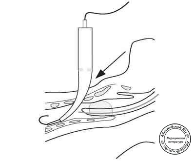 Этапы чрескожной трахеостомии: Расширение стомы при помощи дилататора