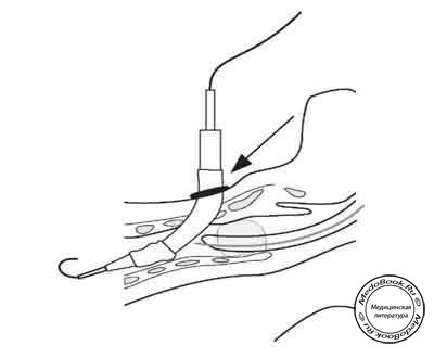 Этапы чрескожной трахеостомии: Введение трахеостомической трубки
