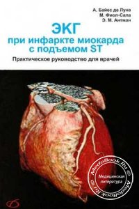 ЭКГ при инфаркте миокарда с подъемом ST, Э. Байес де Луна, М. Фиол, Э. Антман, 2009 г.