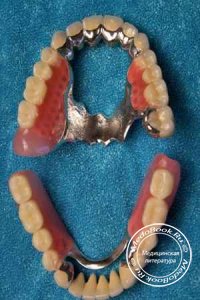 Бюгельные протезы - альтернатива имплантации зубов