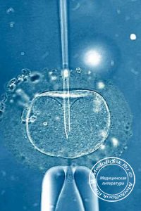 ИКСИ - Интраплазматическое введение сперматозоида