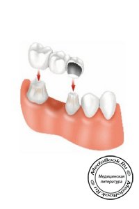 Виды зубных мостов на имплантах