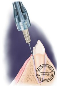 Приемы и методы усиления внепульпарной анестезии