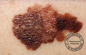 Типичные признаки рака кожи - меланомы