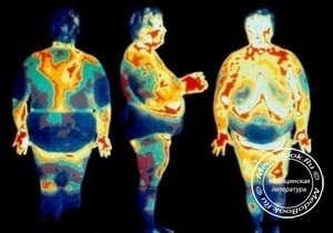 Вид больного ожирением в инфракрасном диапазоне