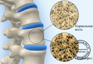 Развитие остеопороза позвоночного столба