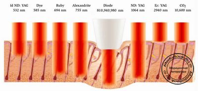 Проникновение излучение в кожу наиболее часто встречающихся в дерматологии лазеров