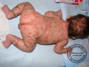 Ребенок с мастоцитозом (пигментной крапивницей)