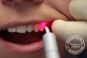 Особенность лазерной стоматологии