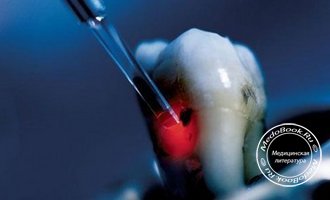 Отбеливание зубов в лазерной стоматологии