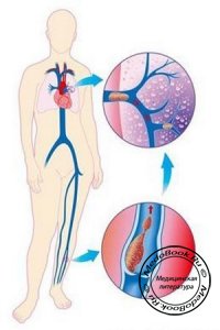 Лечение тромбоза глубоких вен (ТГВ)