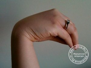Рука акушера - признак гипопаратиреоза