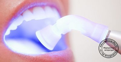Способ отбеливания зубов с помощью лазера