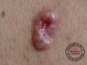 Рак кожи: Опухоль клеток Меркеля