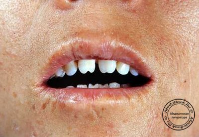 Зубы Гетчинсона - типичны пример системной гипоплазии зубов