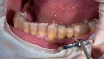 Тетрациклиновые зубы - вариант системной гипоплазии зубов, связанной с приемом тетрациклина
