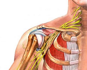 Неврит плечевого нерва