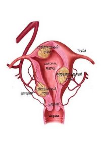 Как проводится операция при миоме матки