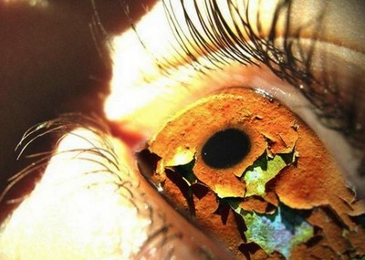 Синдром сухого глаза - ксерофтальмия
