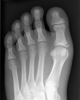 Рентгенография перелома I пальца