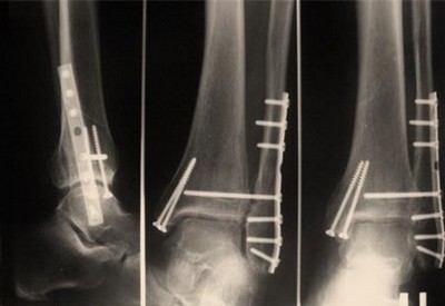 Рентгенография лодыжек после остеосинтеза
