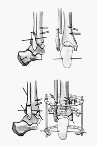 Лечение перелома лодыжки хирургическим путем
