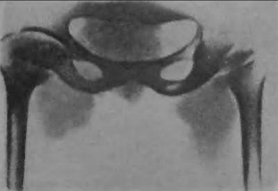 Рентгеновский снимок тазобедренного сустава ахондропластика