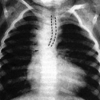 Рентгенодиагностика правосторонней дуги аорты