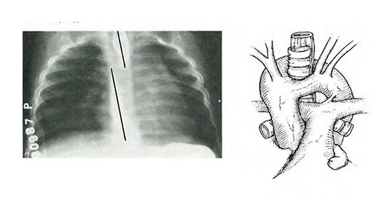 Диагностированная при помощи рентгена двойная дуга аорты