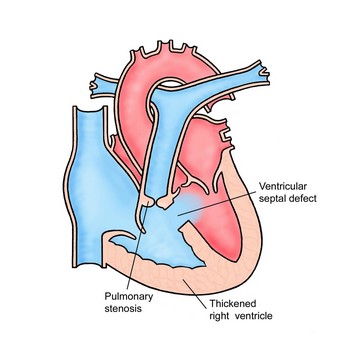 Общее предсердно-желудочковое отверстие - порок, при котором двухстворчатый и трехстворчатый клапаны составляют один общий предсердно-желудочковый клапан