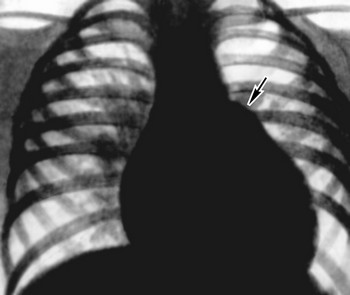 Рентгенологические данные при дефекте межжелудочковой перегородки