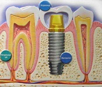 Зубной имплант нижней челюсти