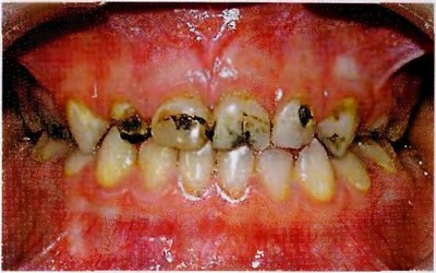 Внешний вид зубов фронтальной группы, ранее обрабатывавшихся раствором серебра, у девочки 4 лет 2 мес