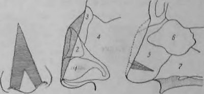 Схема операции уменьшения носа по Йозефу при acromegalia nasi