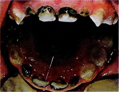 Внешний вид зубов обработанных раствором серебра